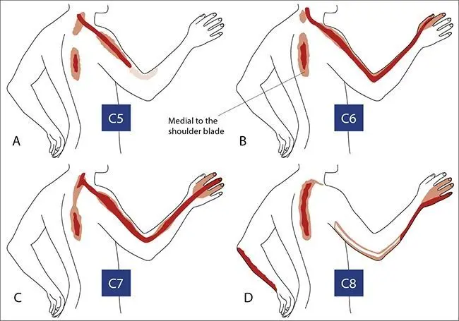Radiculopatía: una guía completa sobre causas, síntomas y tratamiento - Cuál es la diferencia entre el dolor radicular y la radiculopatía motor radiculopathy - Cuál es la diferencia entre el dolor radicular y la radiculopatía